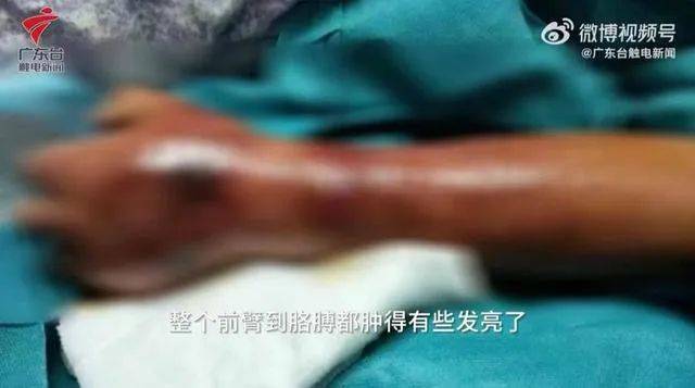 男子被蜘蛛咬伤，手臂肿胀2倍粗，多脏器衰竭！普通人被咬应这样急救！